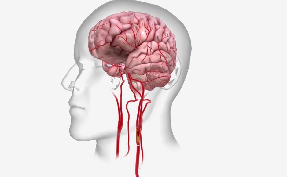 Neurological Conditions