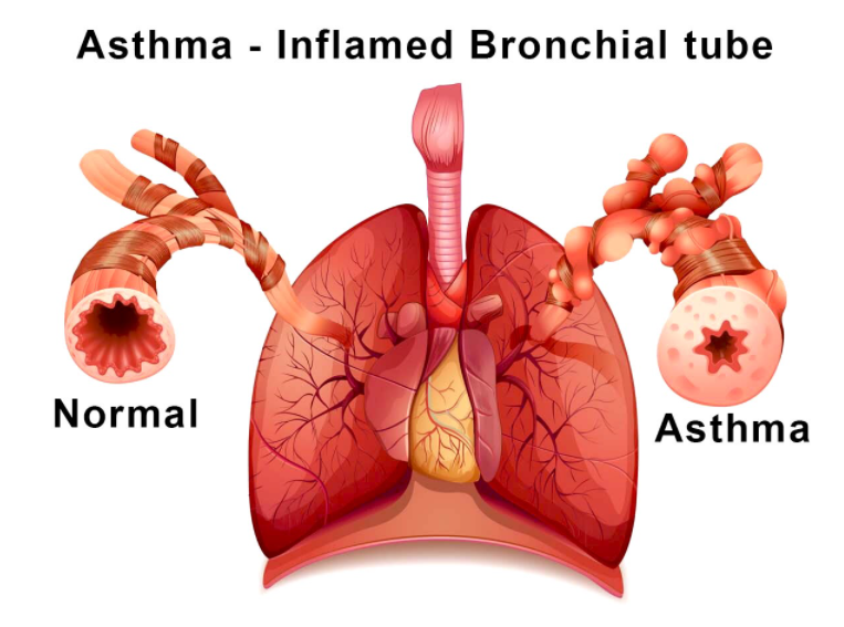 Respiratory Disorders